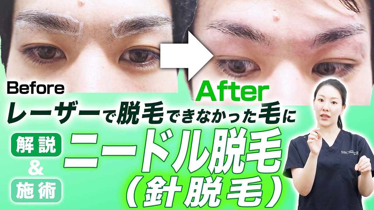 【針で脱毛？】ニードル脱毛の解説&施術をお見せします。