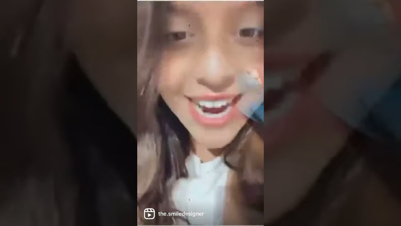 Lingual Braces bonded at The Smile Designer in South Preston, Melbourne