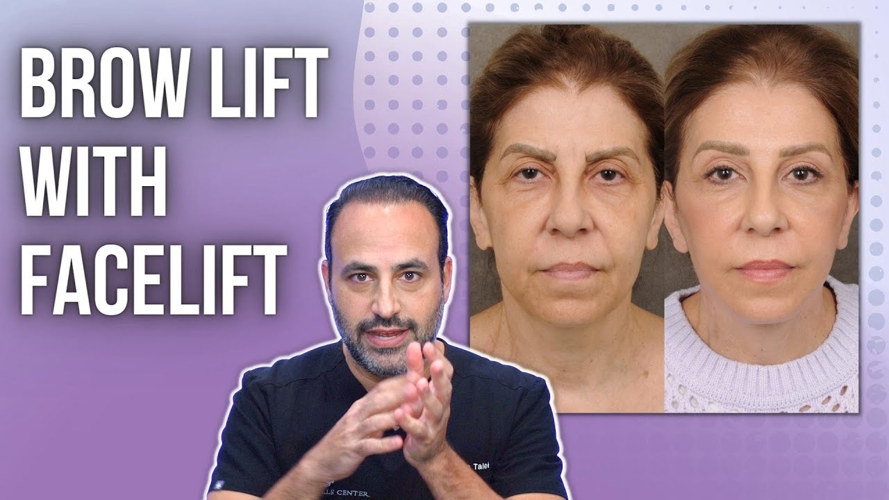 Do I Need a Brow Lift with my Facelift?! | Lesson of the Day