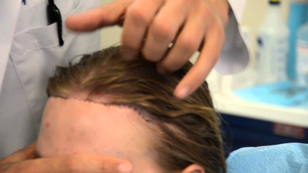 Dr. Epstein - Post Surgery Hairline Advancement