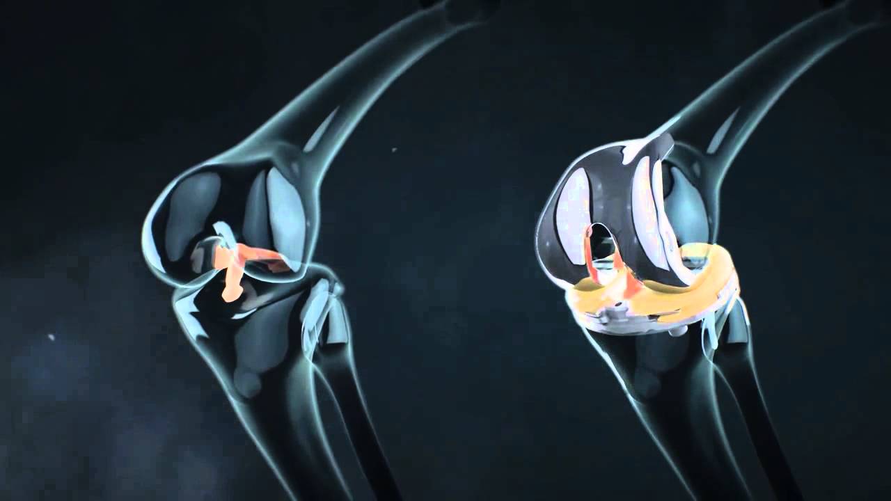XP Knee Replacement