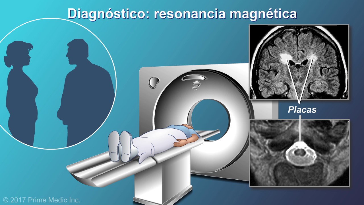 Diagnóstico de la esclerosis múltiple