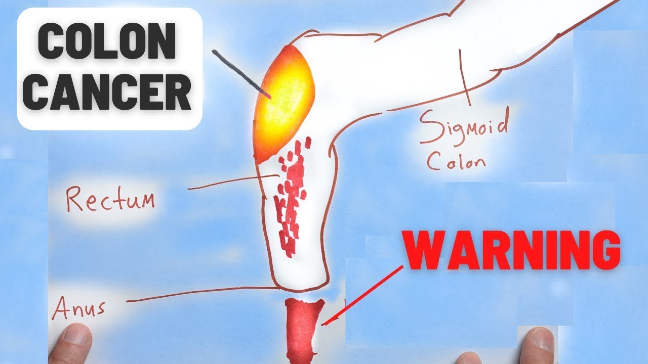 Warning Signs of Colon Cancer You Shouldn't Ignore | Early Detection Tips