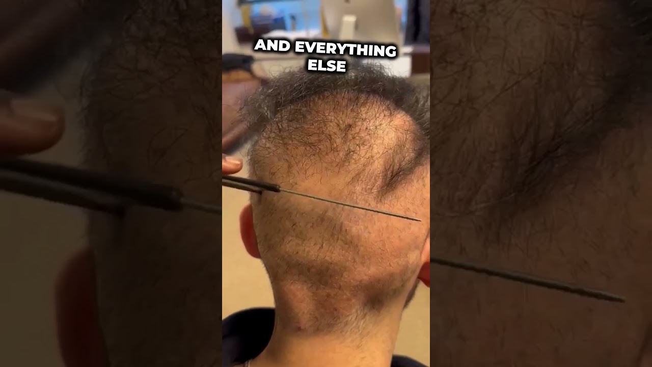 POOR HAIR TRANSPLANT RESULT: The worst use of 14,000 grafts imaginable!  #hairtransplantresults