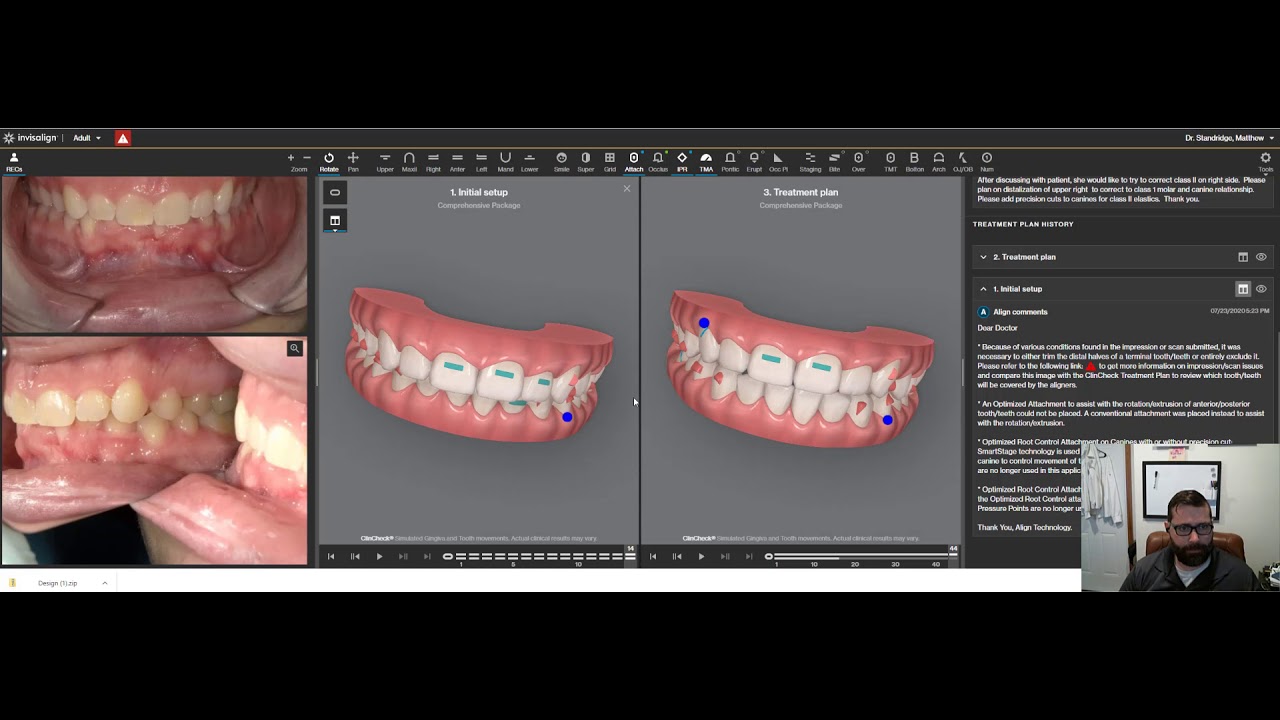 Invisalign or Aligner Distalization Mechanics Case Example 1