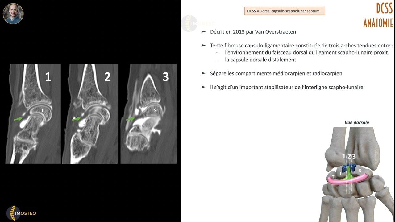 Anatomie et imagerie du DCSS