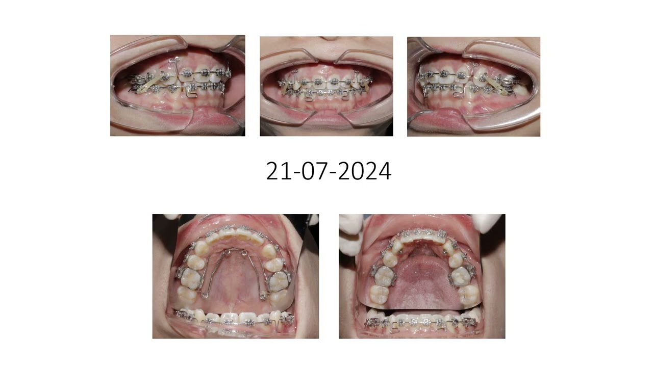 Case nhổ răng với mục tiêu đóng khoảng tịnh tiến vùng răng cửa