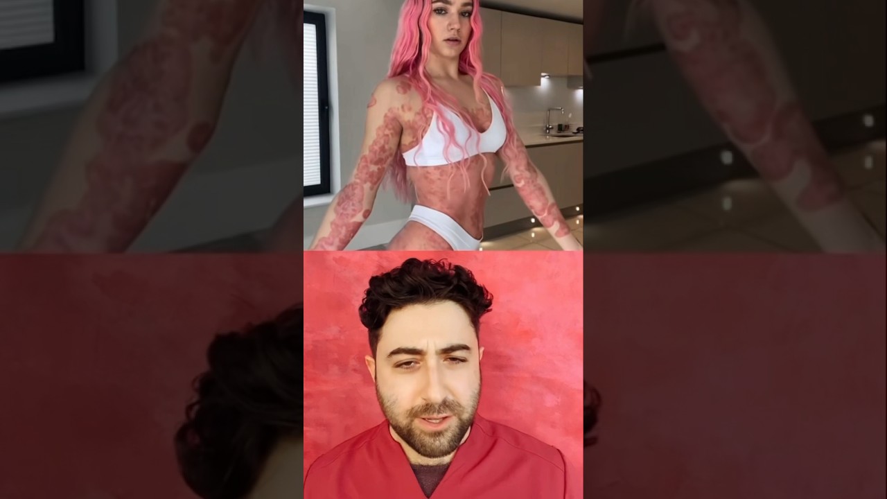 SEVERE psoriasis - Rosie&rsquo;s journey