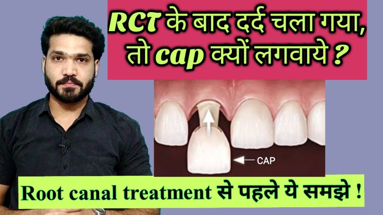 RCT  के बाद capping क्यों ?? Why capping is needed after root canal treatment ?