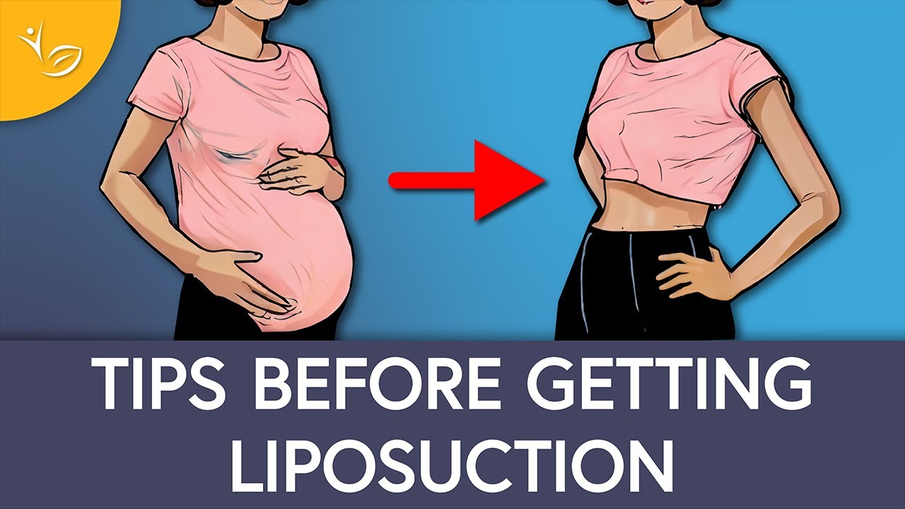 What To Know Before Getting Liposuction