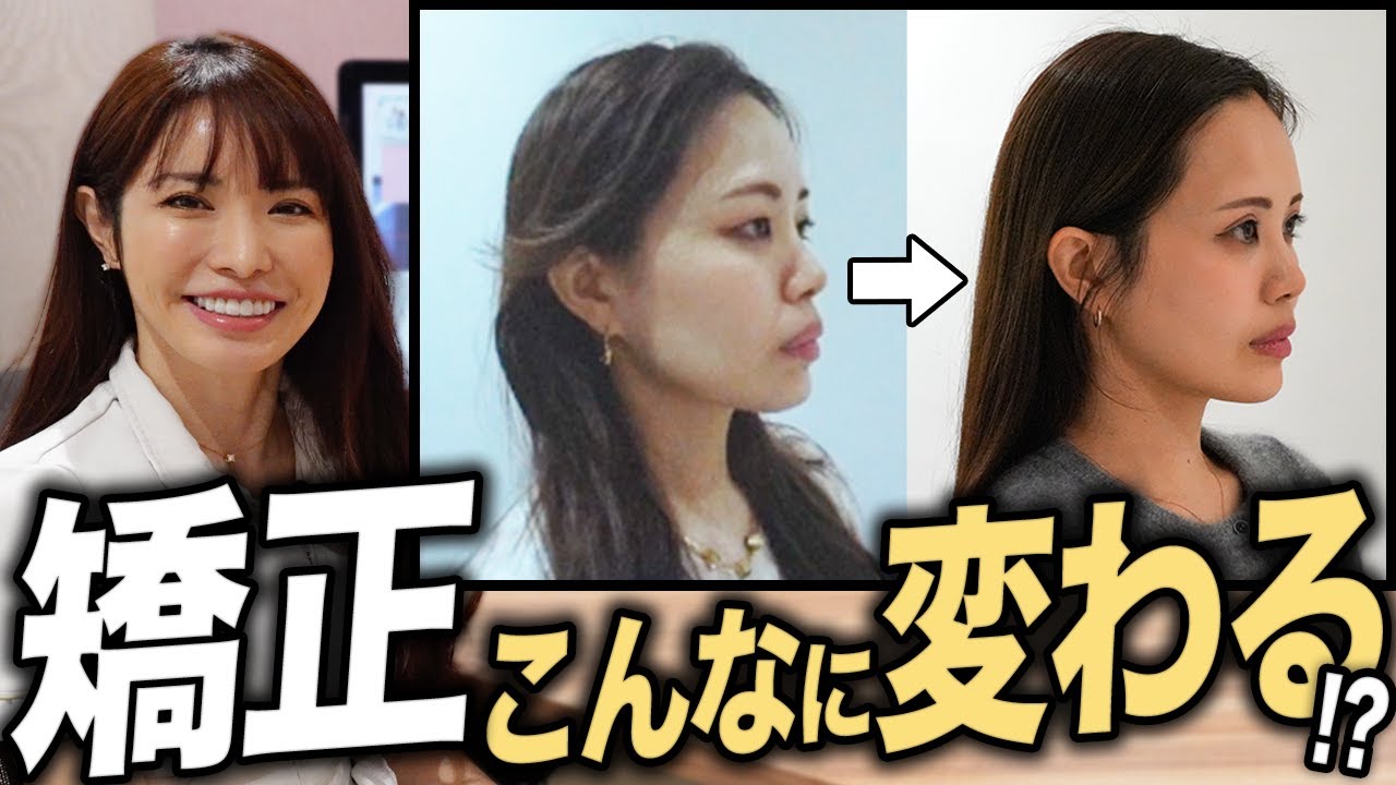 【裏側矯正】症例公開！矯正中の痛みと費用について患者様にインタビューしました！【歯医者｜ワイヤー矯正｜マウスピース矯正】
