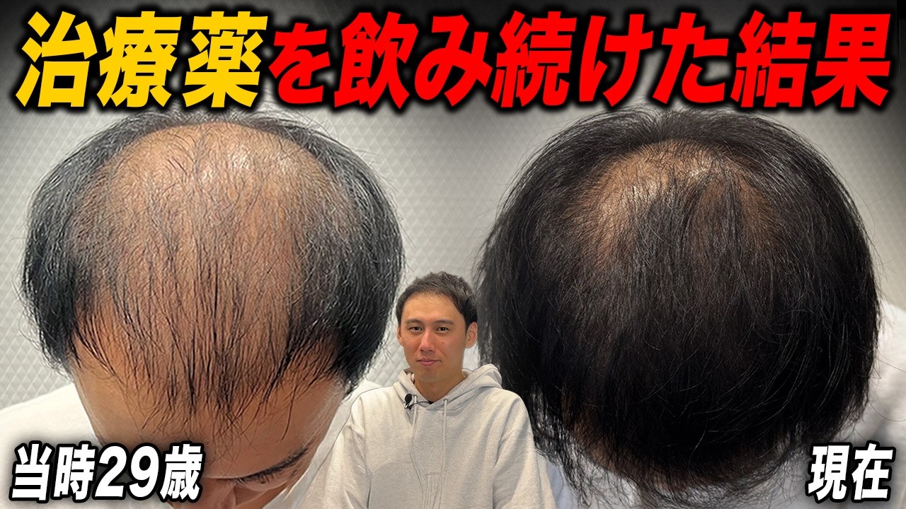 【10代から薄毛】2年4ヶ月AGA治療薬だけを飲み続けた結果...