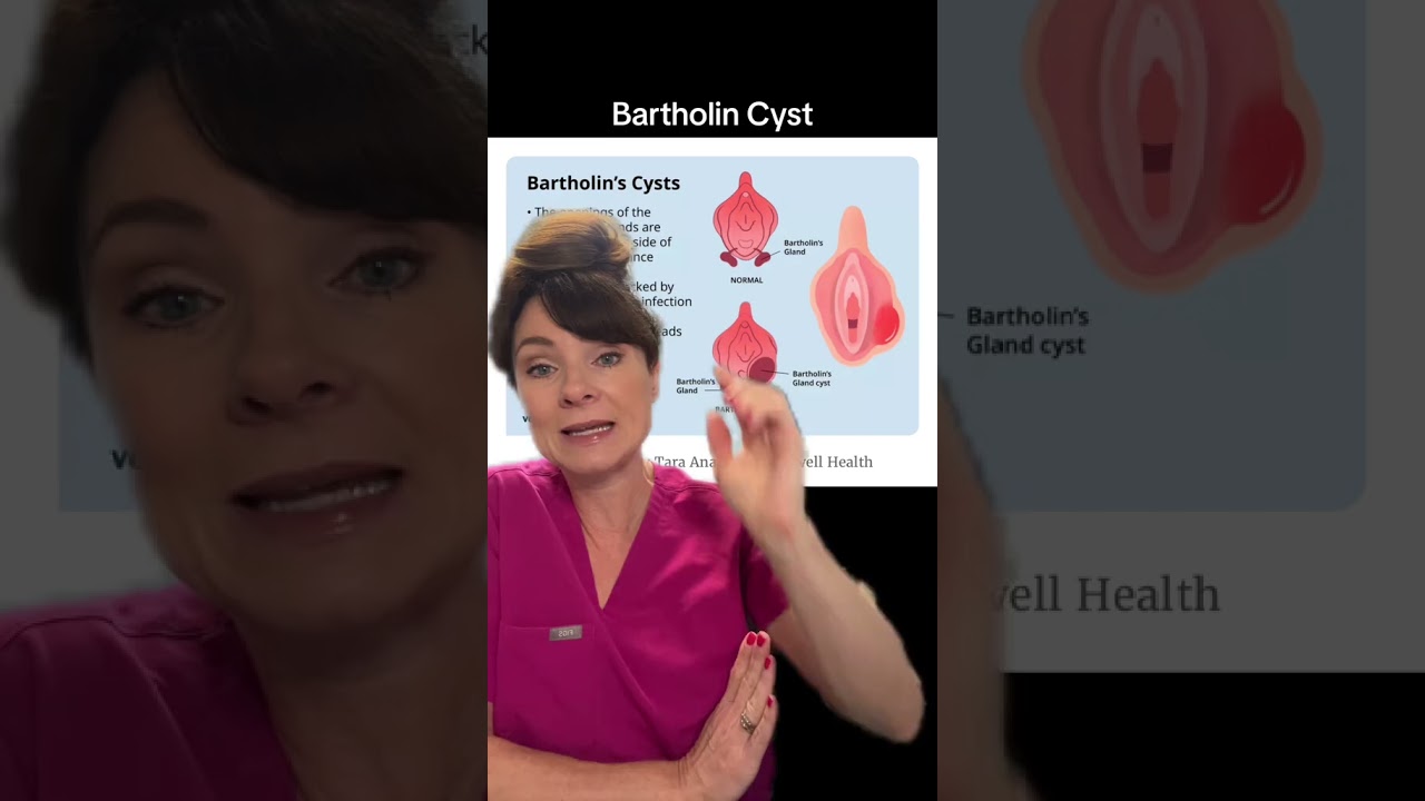 Bartholin cysts are pretty common