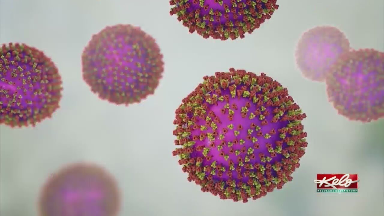 Recent case of measles comes from Brookings County