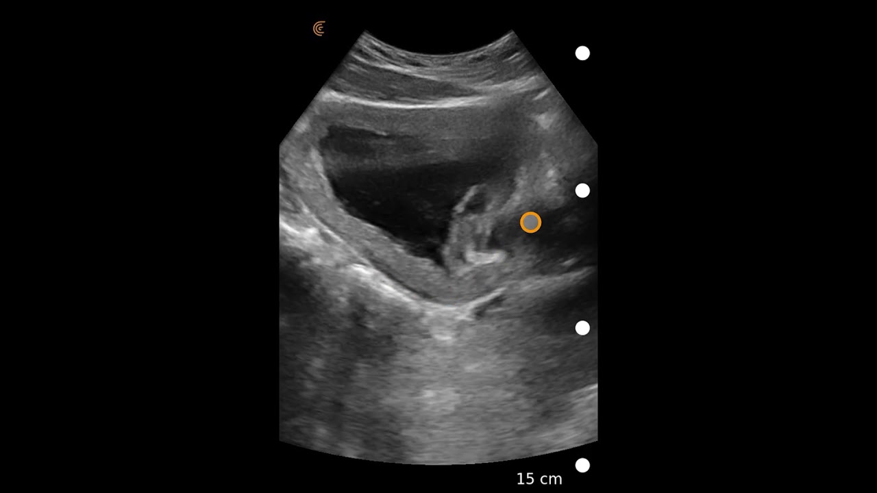 Bladder Debris: Ultrasound Image Interpretation