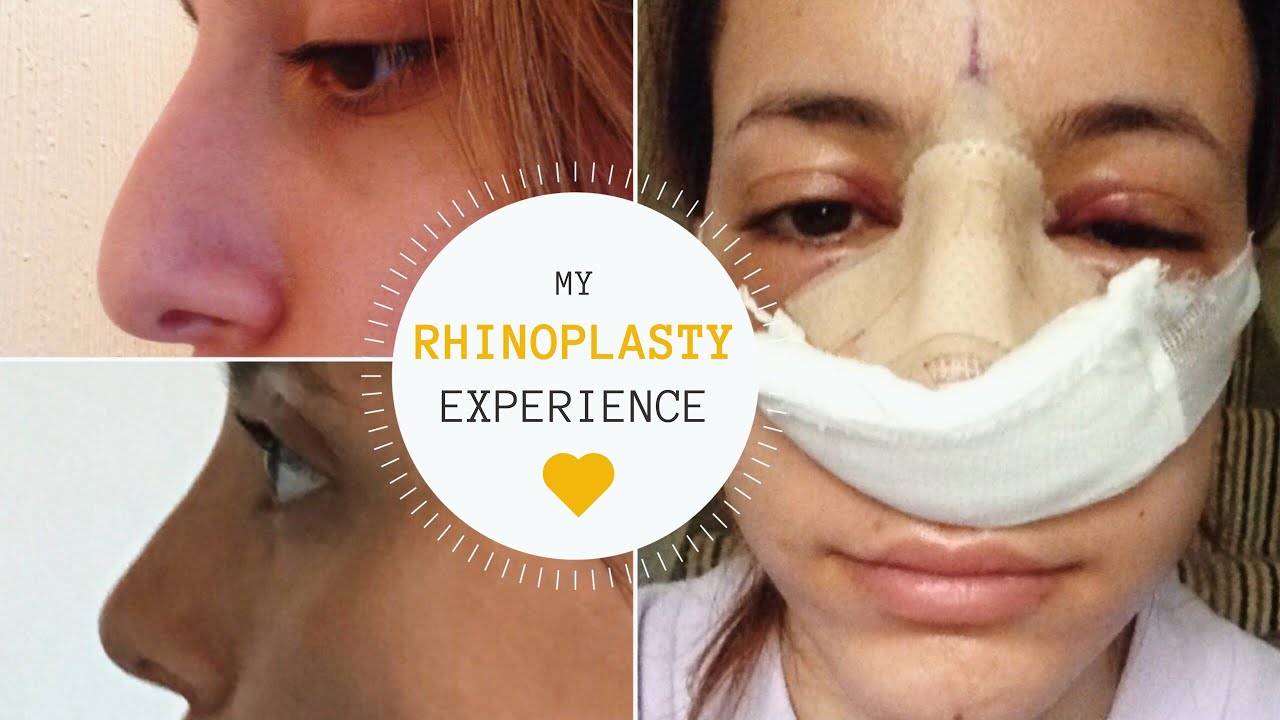 I GOT A NOSE JOB | THE BEST SURGEON  | Rhinoplasty Experience