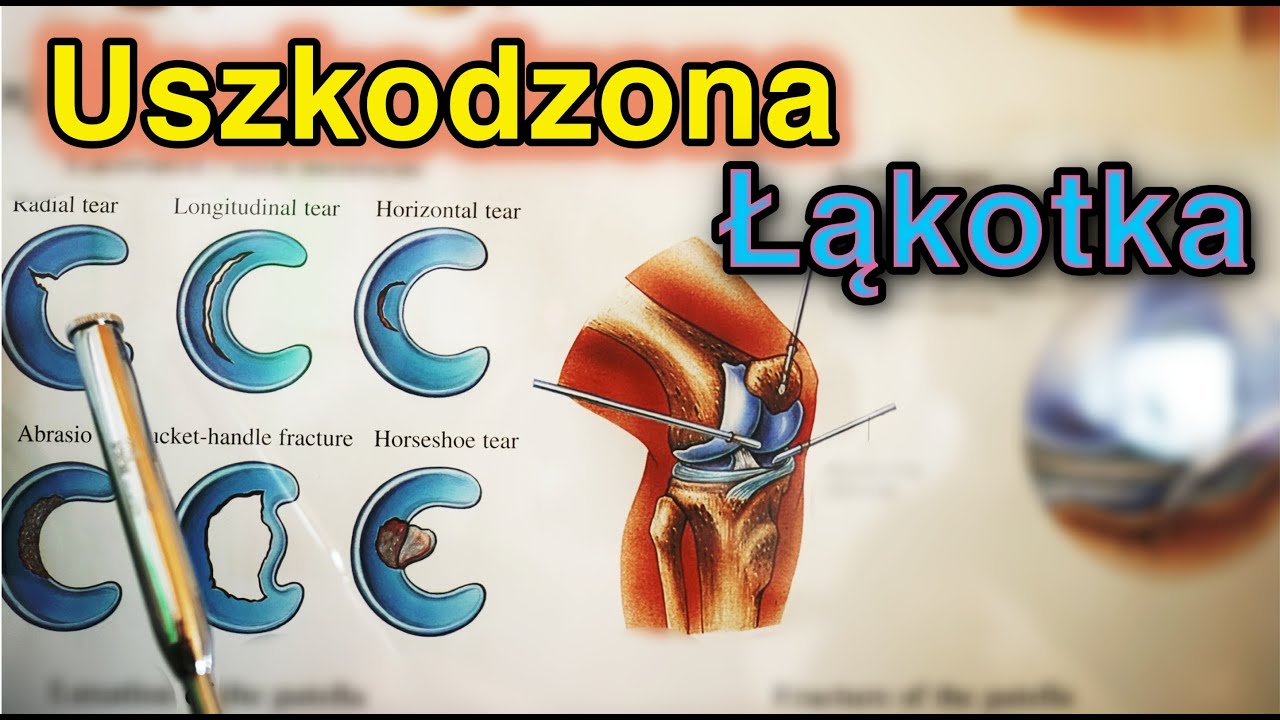 Łąkotka. Uszkodzenie łąkotki. Tejpowanie łąkotki. Meniscus taping.