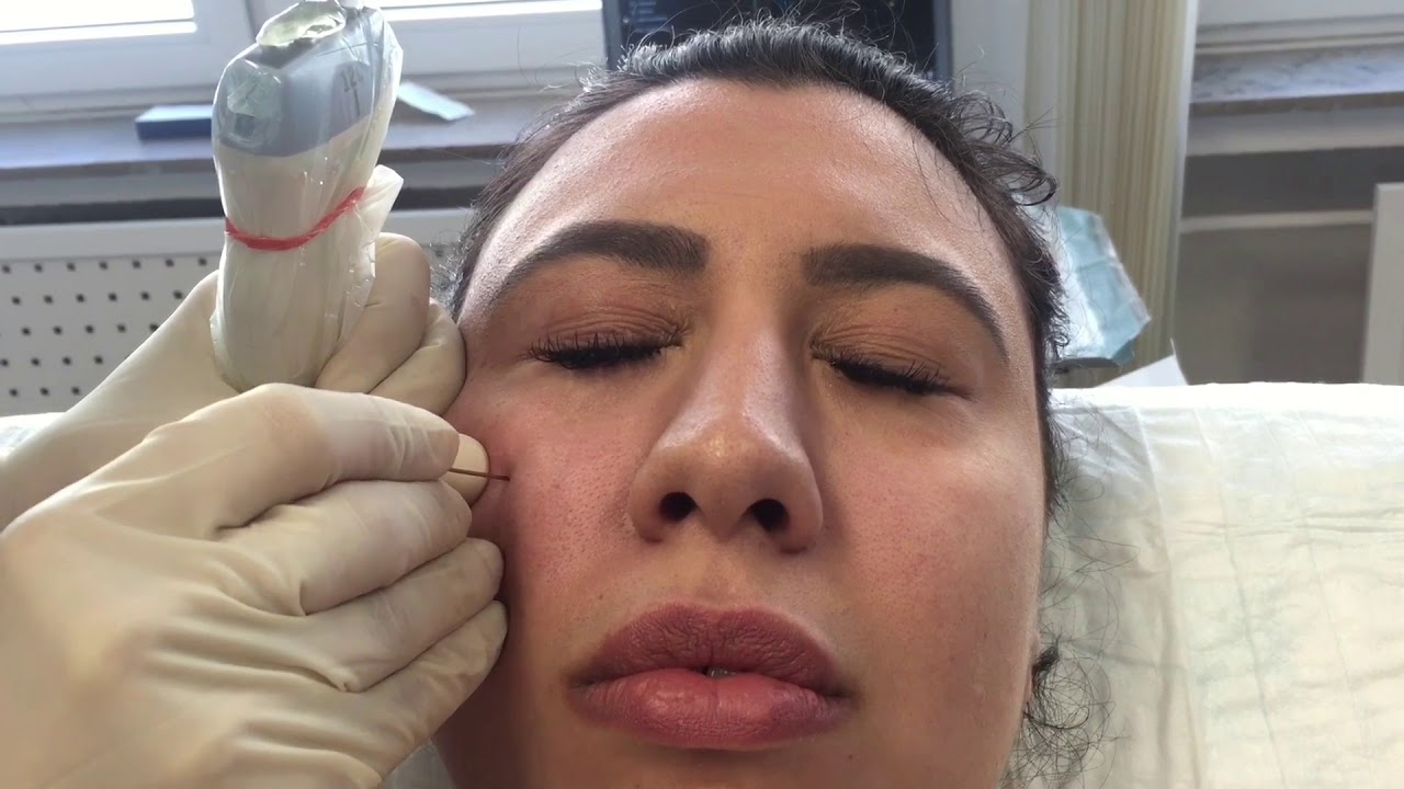 Ultraschall Kontrollierte Unterspritzung: Augenringe unterspritzen mit Hyaluronsäure Dr. Ahlemann