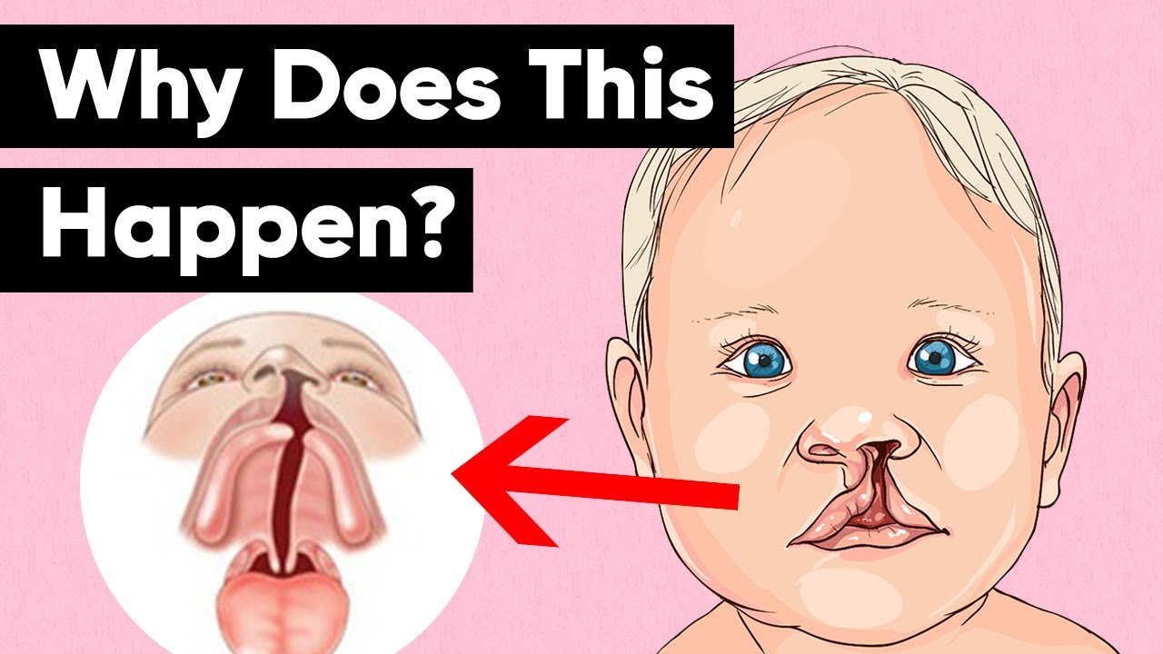 Cleft Lip & Cleft Palate Explained