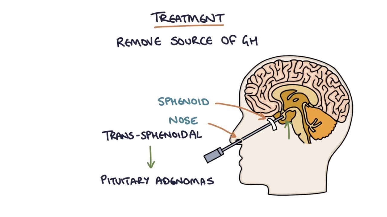 Understanding Acromegaly