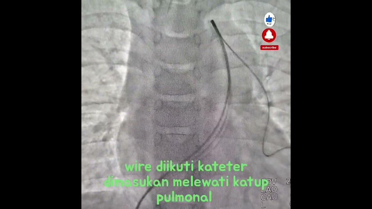 Proses tindakan ballon katup pulmonal yang menyempit/stenosis #cathlab #pediatric #jantung