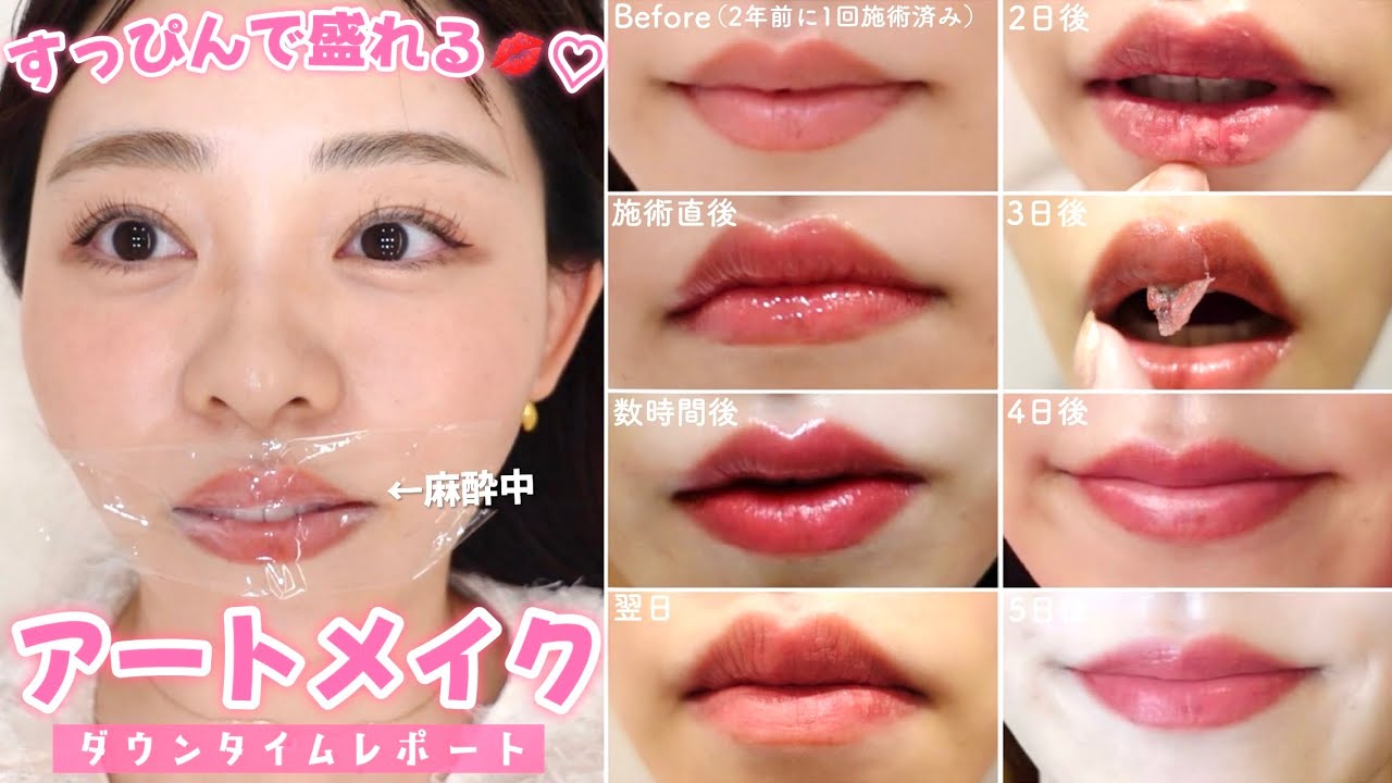 【アートメイクですっぴんも可愛く💋】施術直後からダウンタイムが終わるまで全部見せ🫣値段＆クリニックも公開！