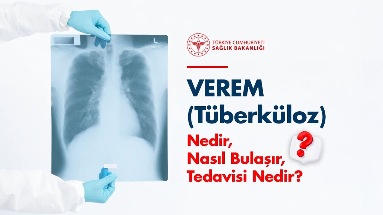 Verem (Tüberküloz) Nedir,  Nasıl Bulaşır, Tedavisi Nedir? 