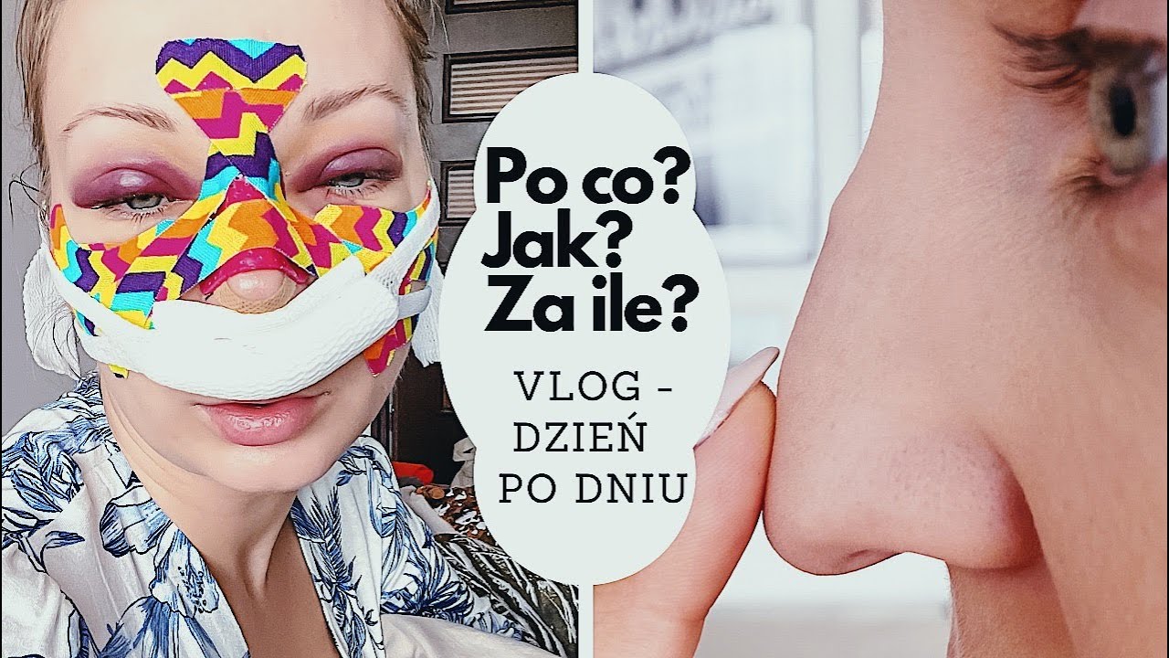 ZROBIŁAM OPERACJĘ NOSA 😱 VLOG BEZ TABU