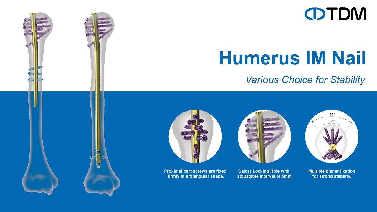 [TDM Korea] Humerus IM Nail