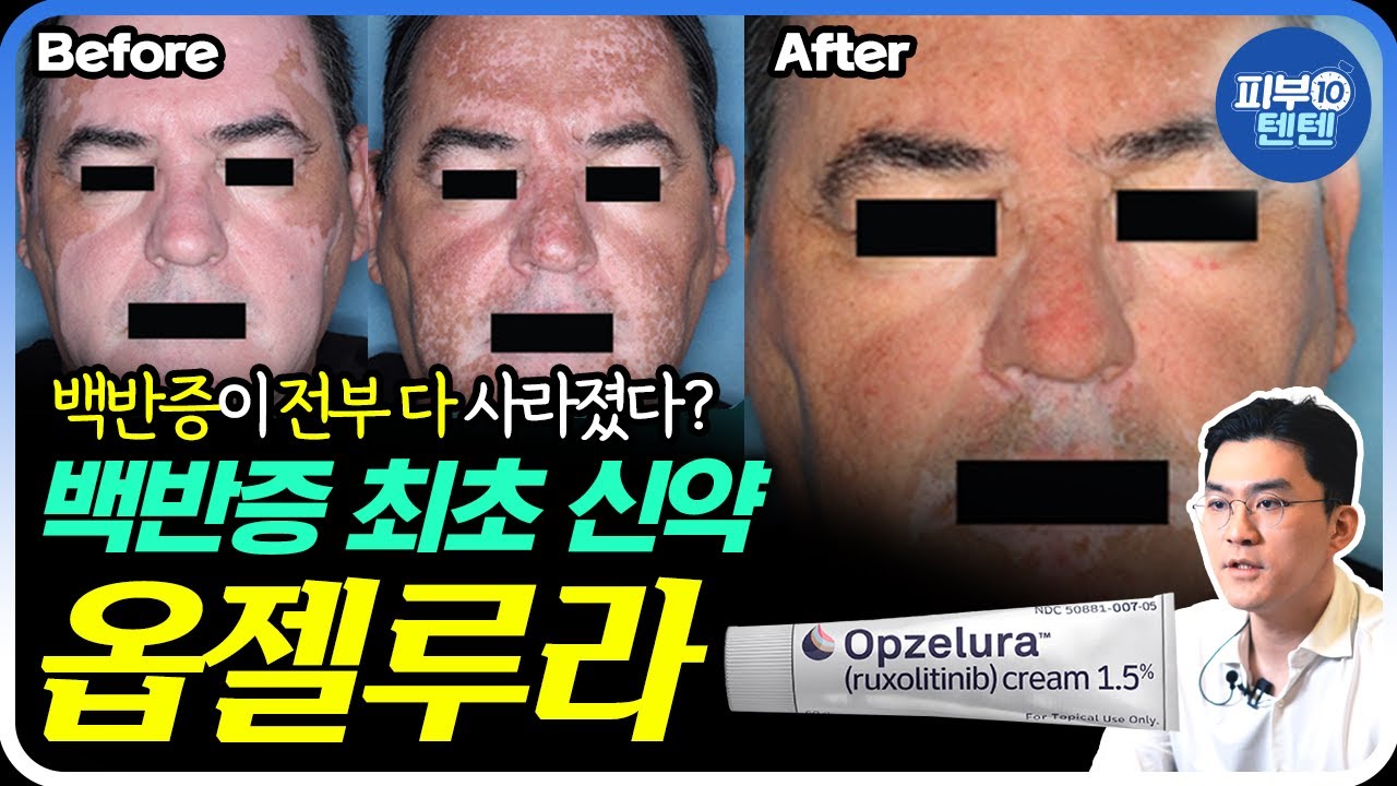 백반증 신약 옵젤루라에 대해 알려진 모든 것: 효과, 가격, 논문 분석, 국내 도입 전망까지  | 백반증 백반증치료 백반증연고 백반증약 피부과전문의 백반증피부과