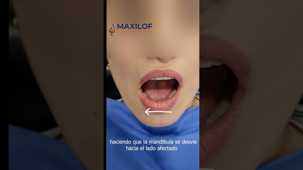 Tu mandibula se va de lado 