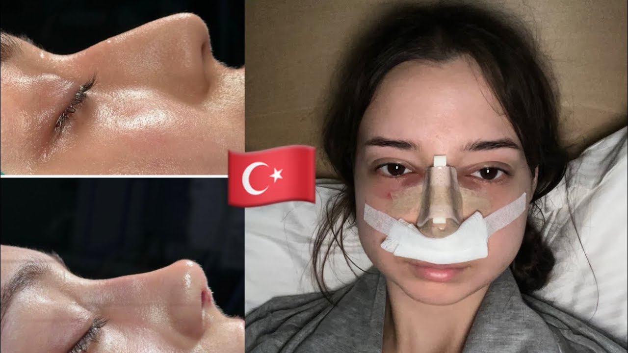 I GOT A NOSE JOB IN TURKEY | Rhinoplasty Vlog with Dr. Yusuf Orhan Ucal at Clinic Hub Istanbul