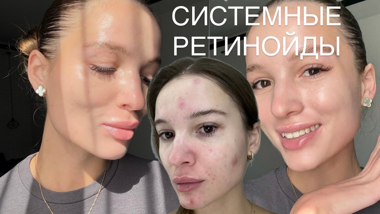 Системные Ретинойды Я ОТКАЗАЛАСЬ ОТ ЛЕЧЕНИЯ Роаккутан
