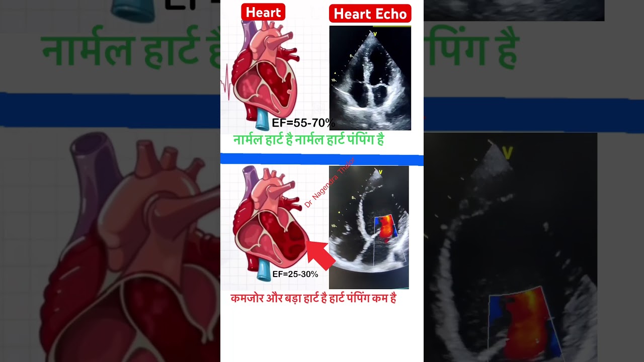Normal heart Ef=55-70% & Heart failure EF=25-30% Echo l #echo #shorts