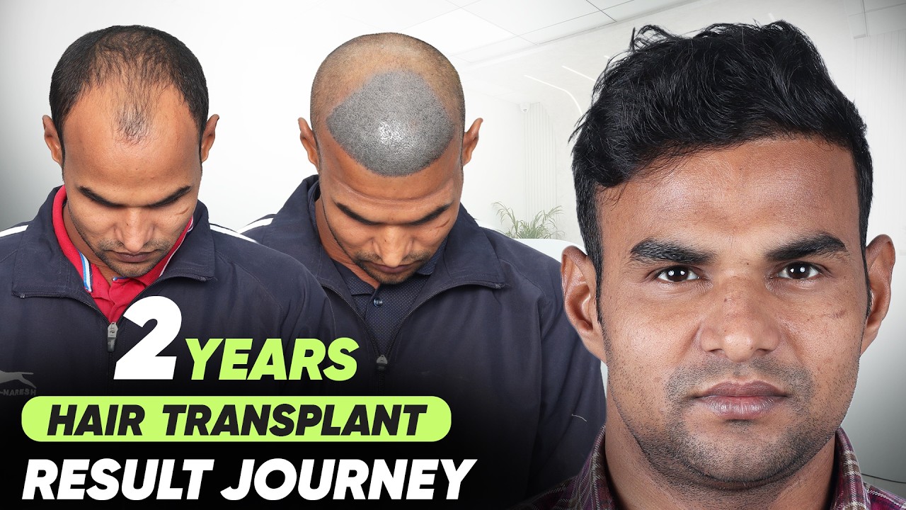 Hair Transplant in Ghaziabad (HX-HAAE) | Best Results & Cost of Hair Transplant in Ghaziabad.