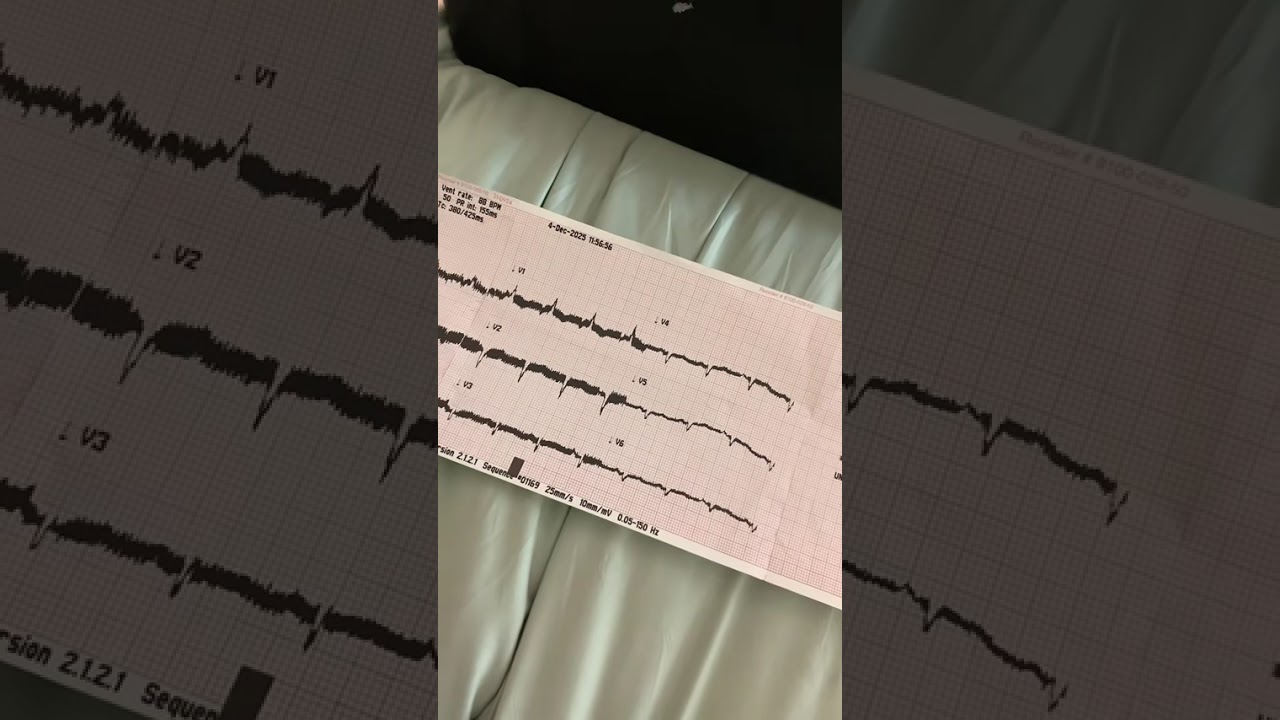 LVAD EKG 
