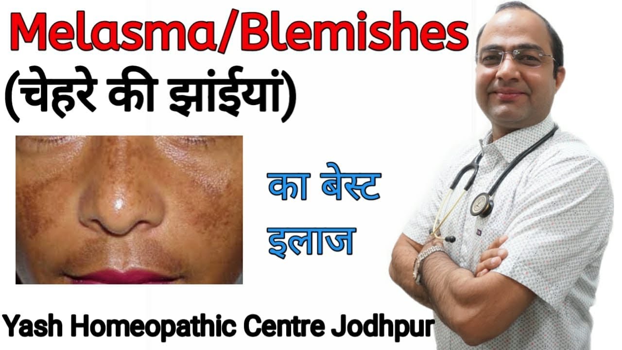 चेहरे पर झाँईयाँ । धब्बे । melasma chloasma blemishes hyperpigmentation