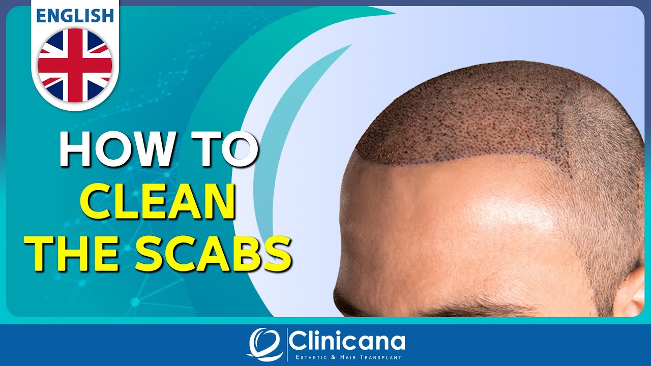 How to clean the scabs after 11 days from the hair transplant operation