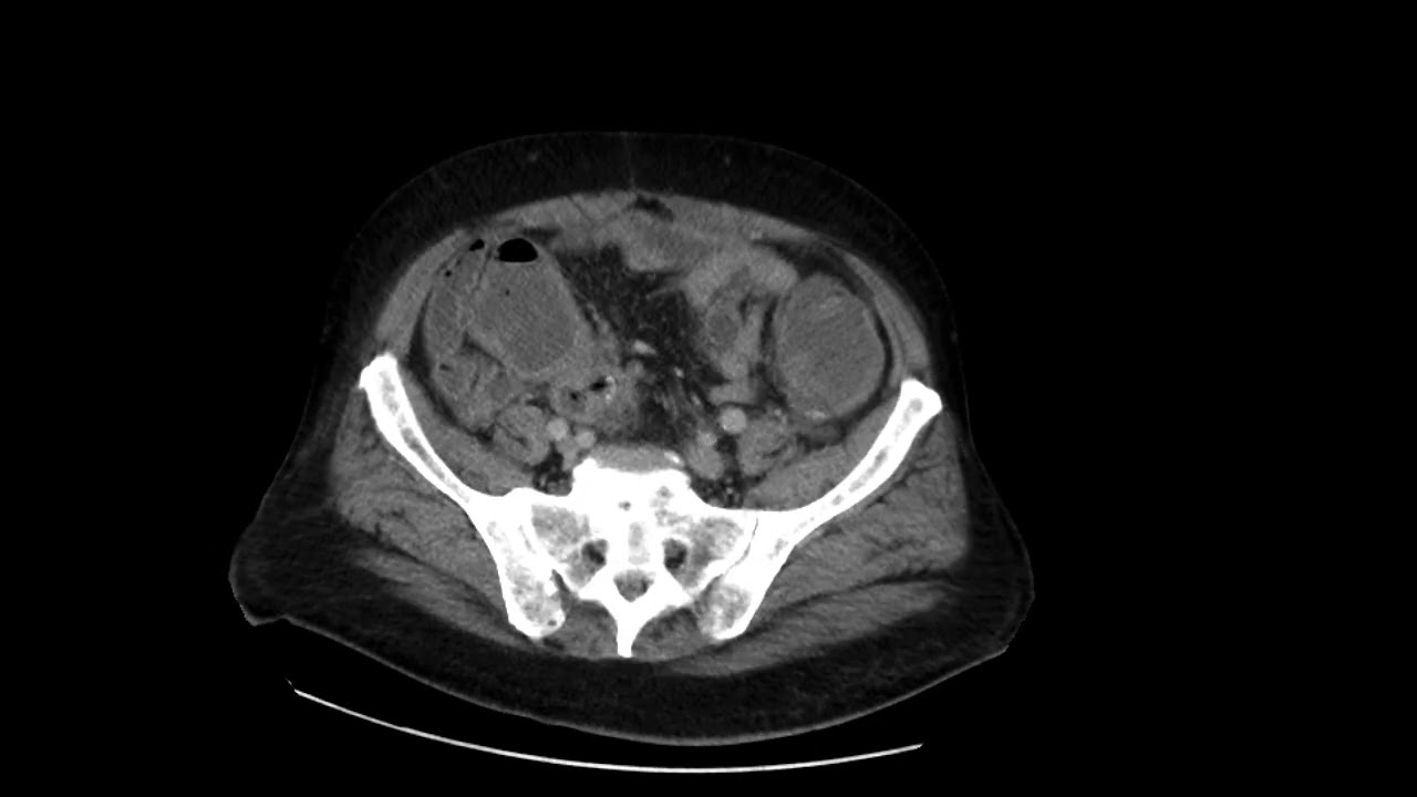 Sigmoid cancer with cecal perforation