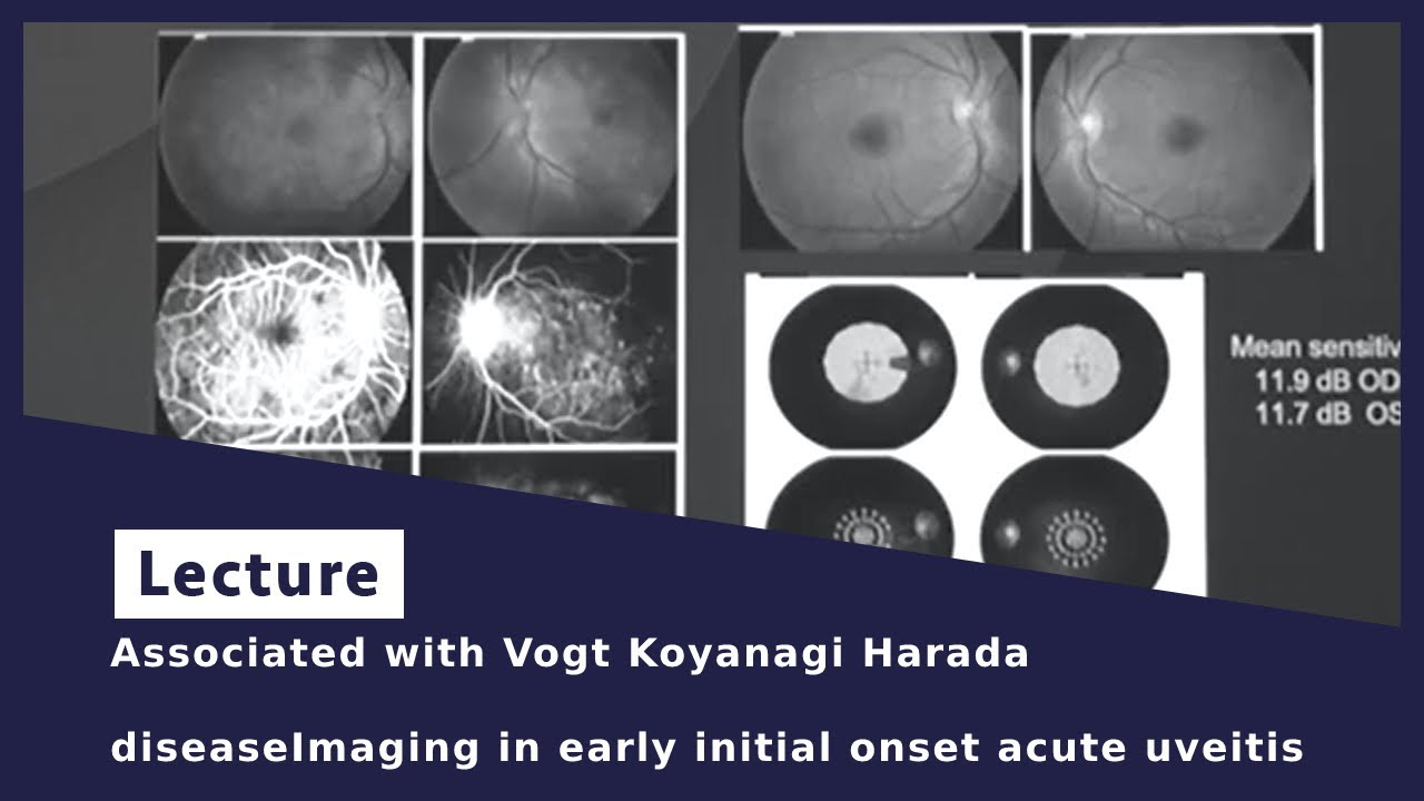 Associated with Vogt Koyanagi Harada diseaseImaging in early initial onset acute uveitis