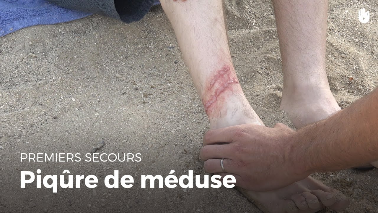 Premiers secours : Piqure de méduse | Secourisme