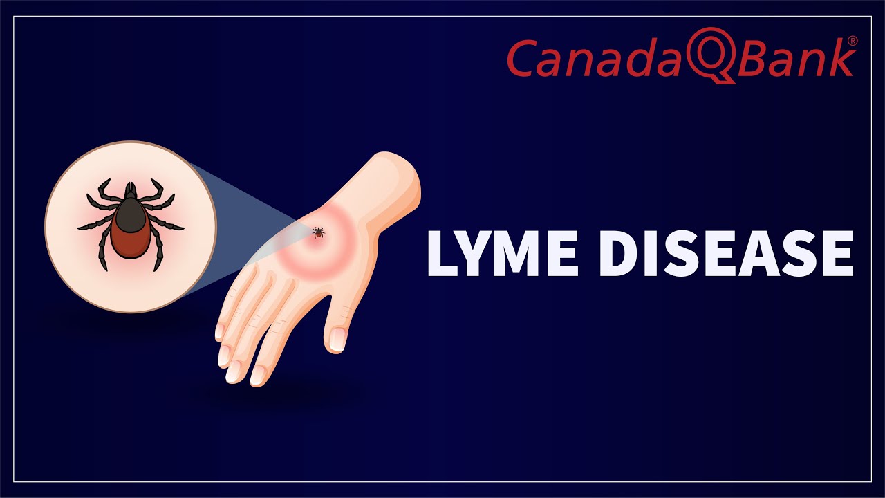 Lyme Disease: Symptoms, Diagnosis & Treatment | CanadaQBank