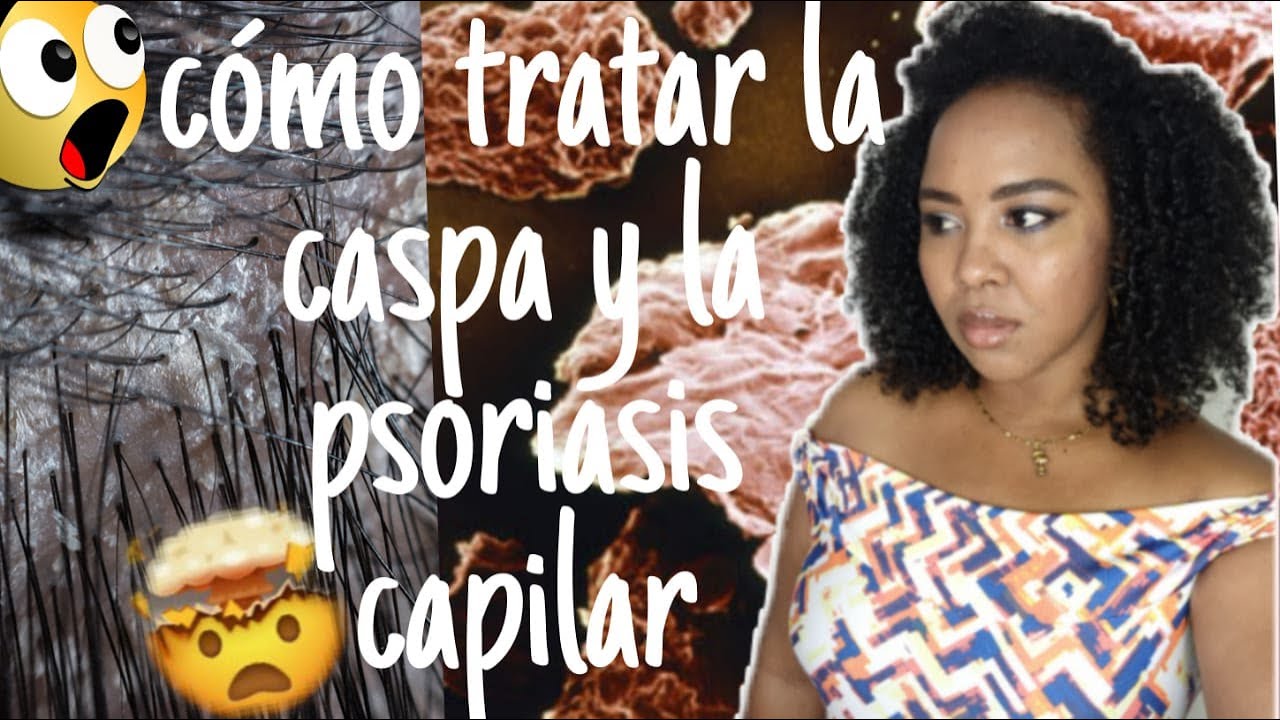 COMO TRATAR LA CASPA Y LA PSORIASIS CAPILAR