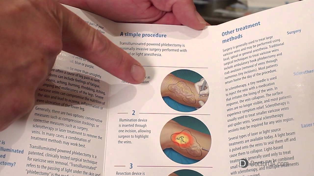 What is transilluminated power phlebectomy? - Dr. Joseph Thomas Jenkins, MD