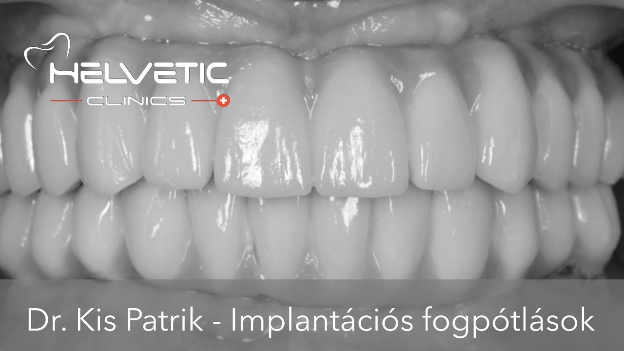 Helvetic Clinics - Dr. Kis Patrik - Implantációs fogpótlások, korona híd implantátumra