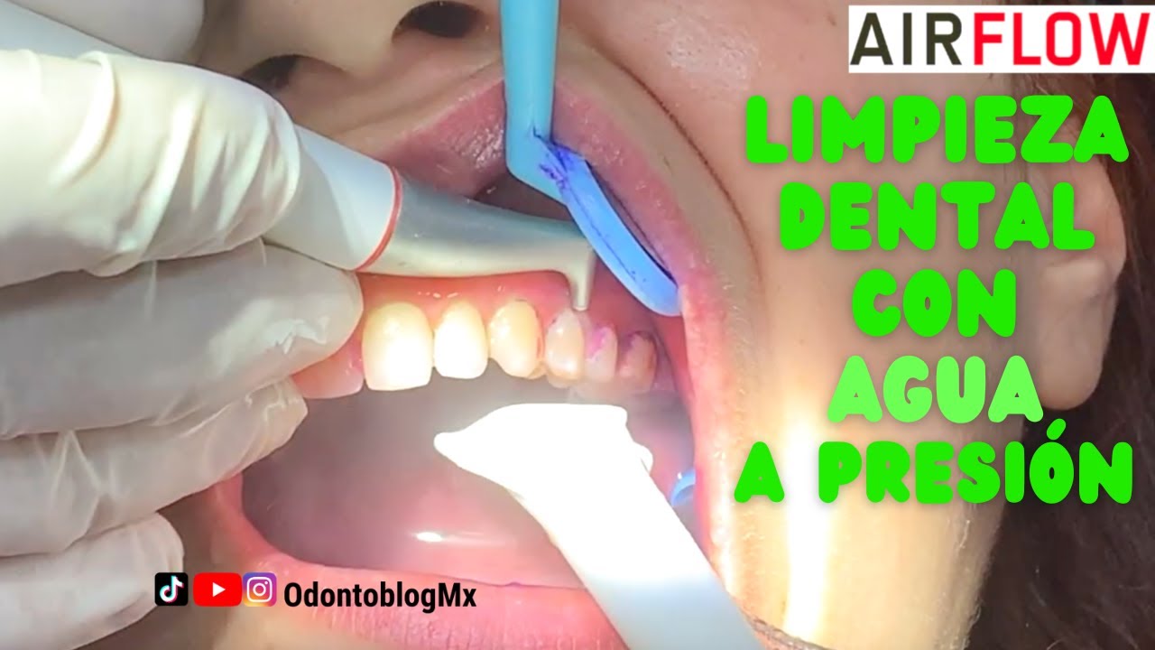 TODO SOBRE AIRFLOW: Limpieza Dental con agua a presión 💦 🦷