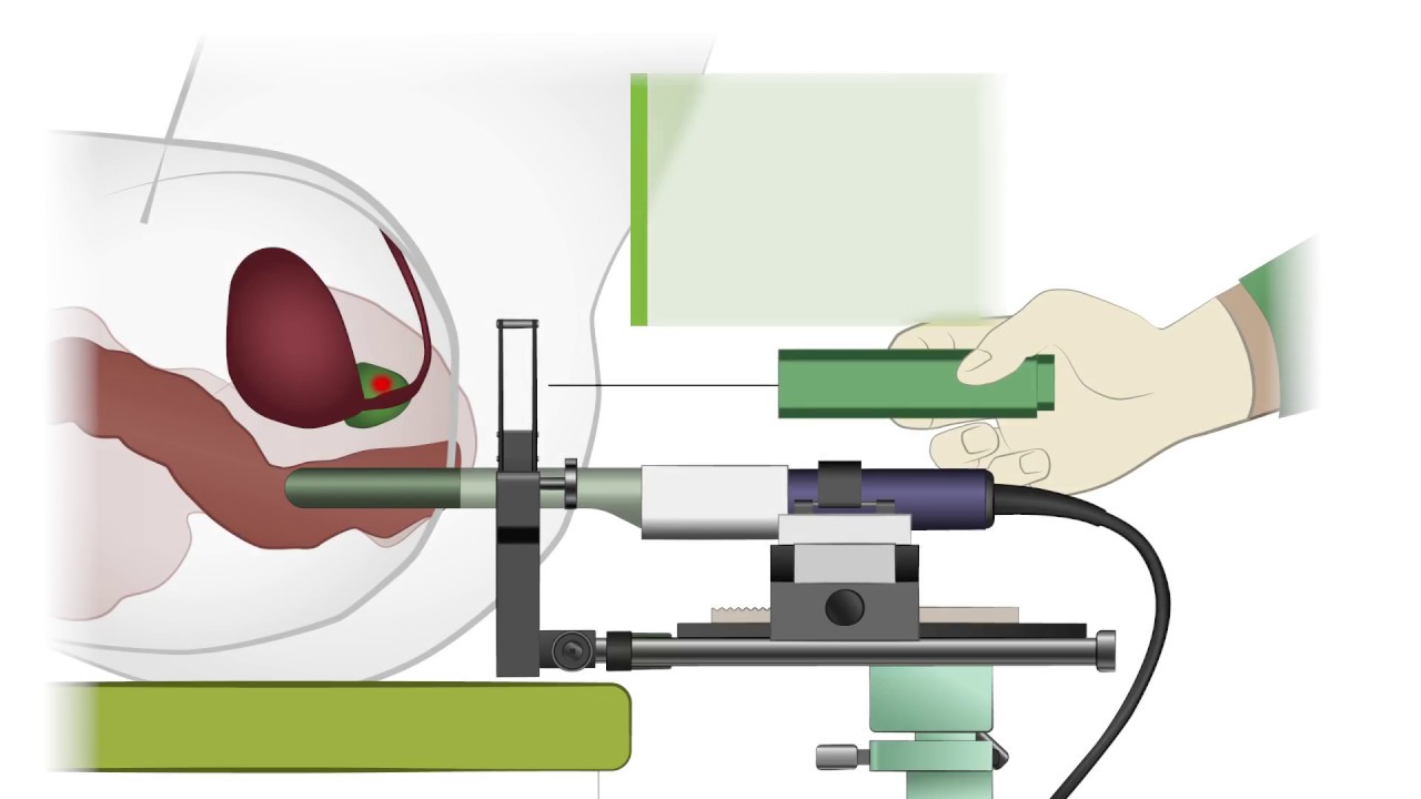 UKMP Fusionsbiopsie der Prostata
