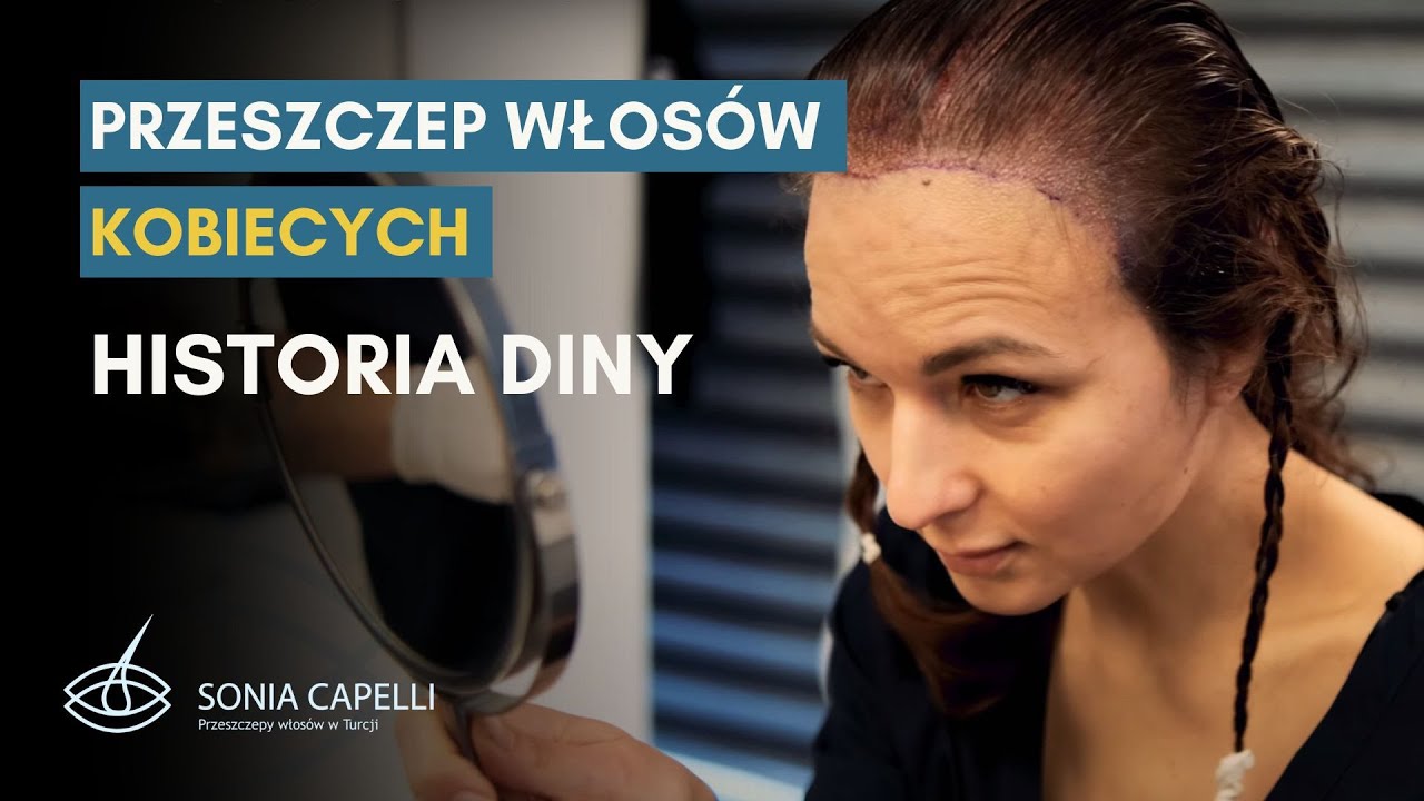 Przeszczep włosów kobiecych- historia Diny | Sonia Capelli