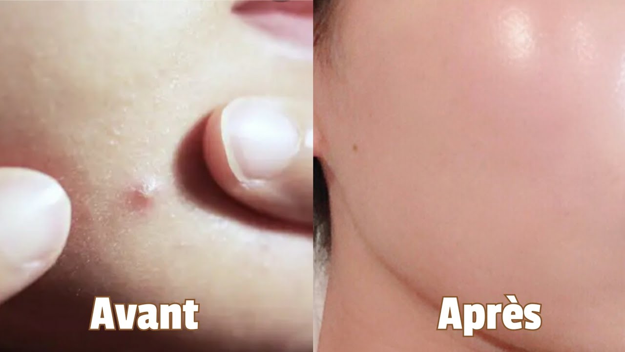 COMMENT FAIRE DISPARAÎTRE LES BOUTONS RAPIDEMENT...EN UNE NUIT ?