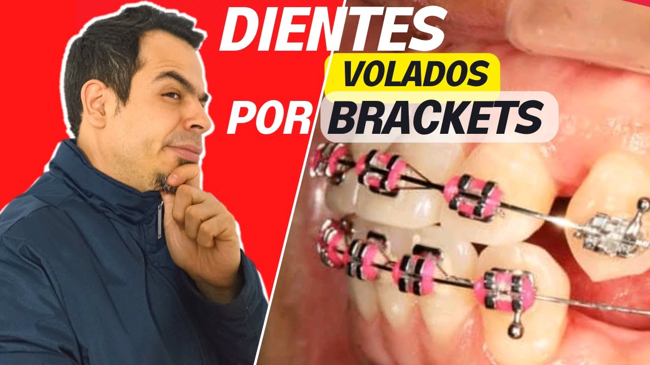 DIENTES VOLADOS O HACIA AFUERA DESPUÉS DE LA ORTODONCIA / ¿POR QUÉ PASA ESTO?